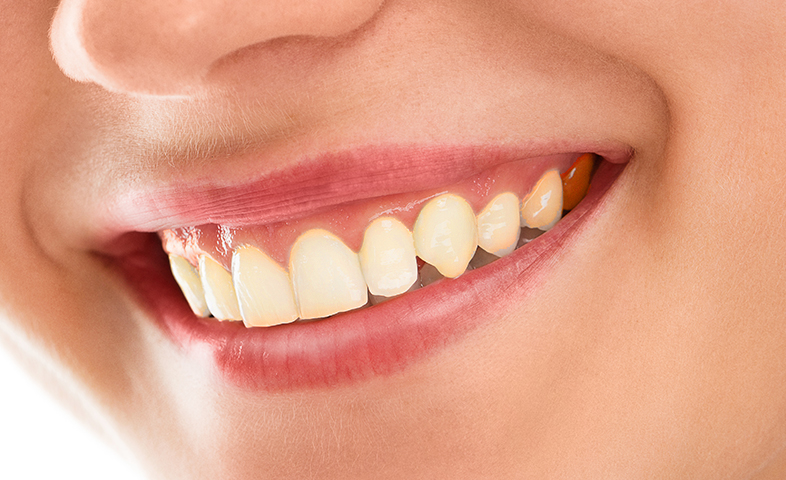 Implantes Dentales - Antes